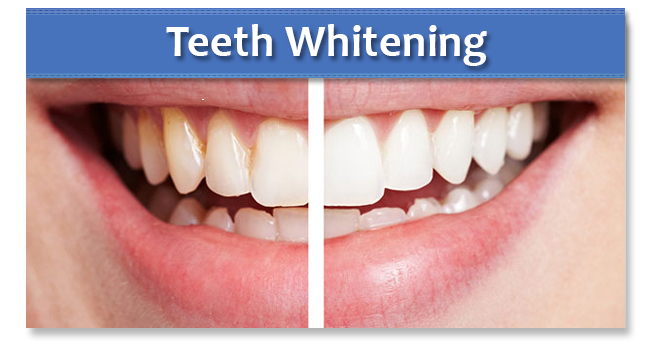 Teeth Whitening Horsham, Sussex | Dental Healthcare Practice