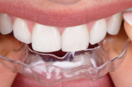 Cosmetic dentistry Horsham - woman putting transparent aligner in top teeth